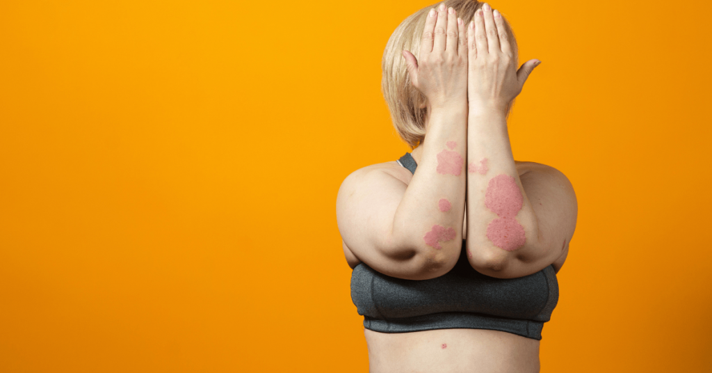 mulher exibindo as urticárias em braço
